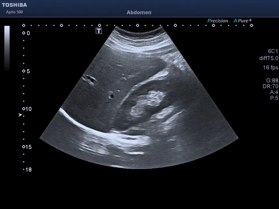 Ultrasound showing the right liver lobe and right kidney