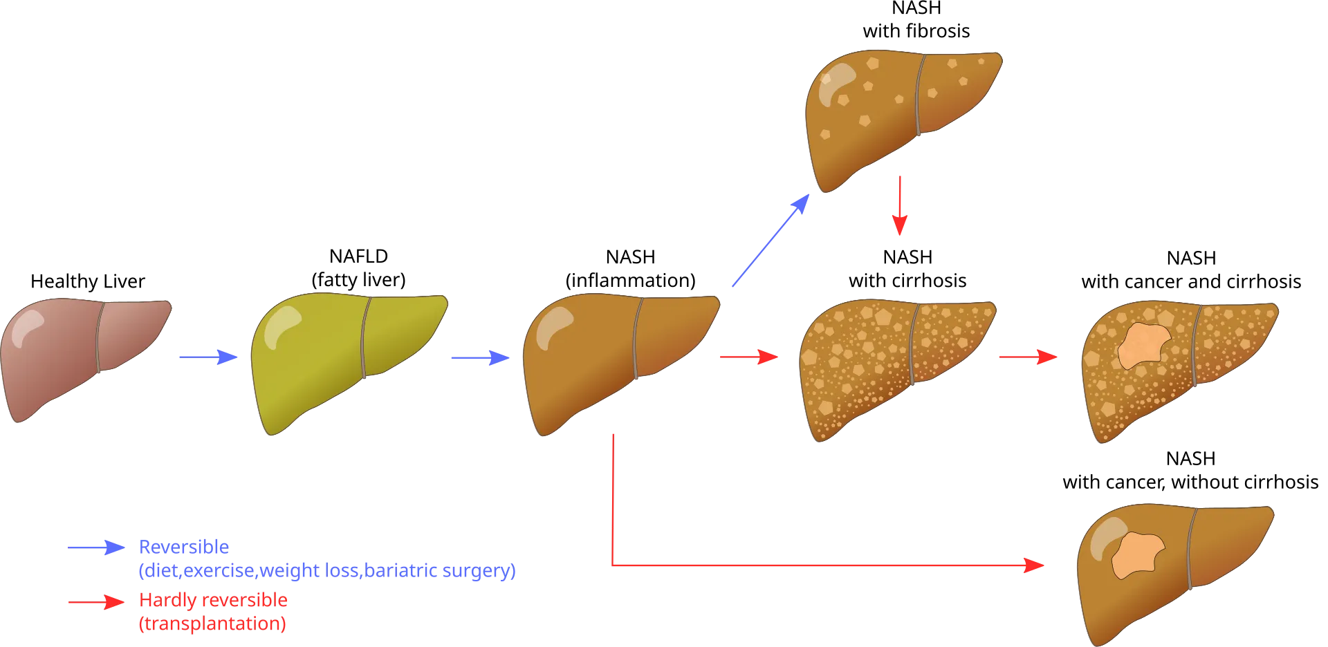 Diagram showing stages of fatty liver disease from fat buildup to cirrhosis